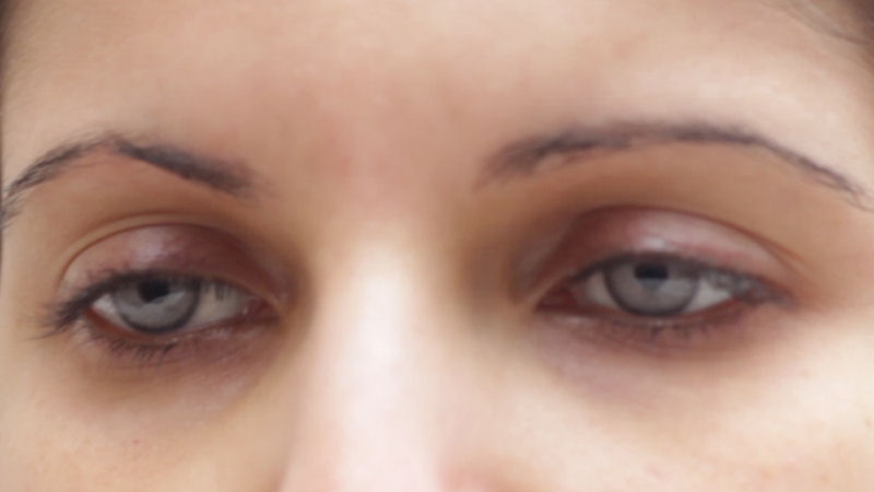 Polêmica cirurgia de implante de íris artificial para alterar permanentemente a cor dos olhos