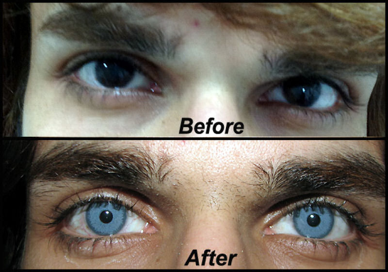 Polêmica cirurgia de implante de íris artificial para alterar permanentemente a cor dos olhos