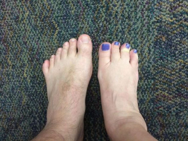 Duas colegas de trabalho tinham uma particularidade parecida em seus pés. Uma tinha 6 dedos em seu pé esquerdo e a outra tinha 4 no direito.