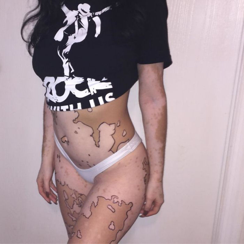 Jovem com vitiligo usa seu corpo como tela para obras artsticas surpreendentes