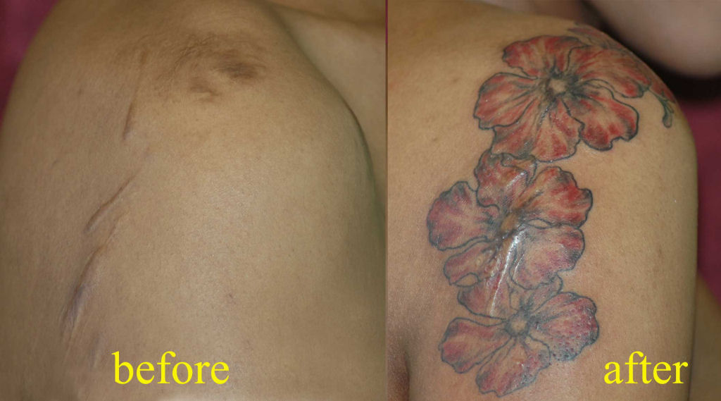 Tatuagens sobre cicatrizes mostram uma maneira incrvel de dissimul-las 32