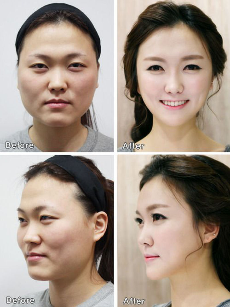 Aps cirurgia plstica chinesas so barradas no aeroporto porque seus rostos no combinavam com o passaporte