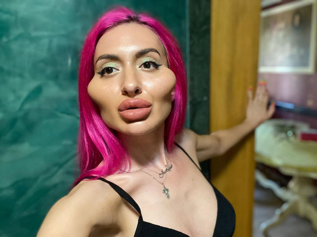Modelo ucraniana fica com rosto deformado por vício de preencher a maçã do rosto
