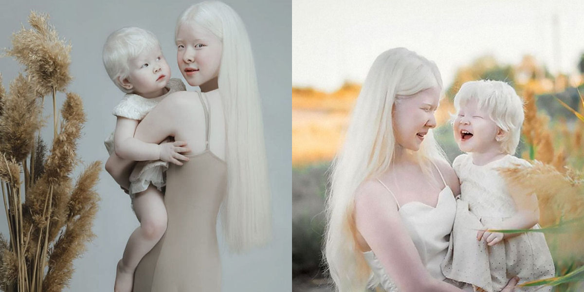 A beleza surpreendente de irmãs albinas nascidas com 12 anos de diferença 01