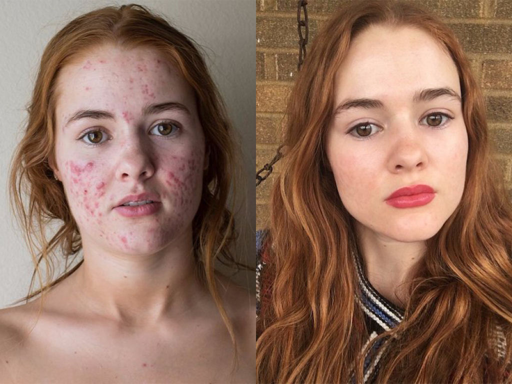 O incrível antes e depois desta jovem com acne severa 01