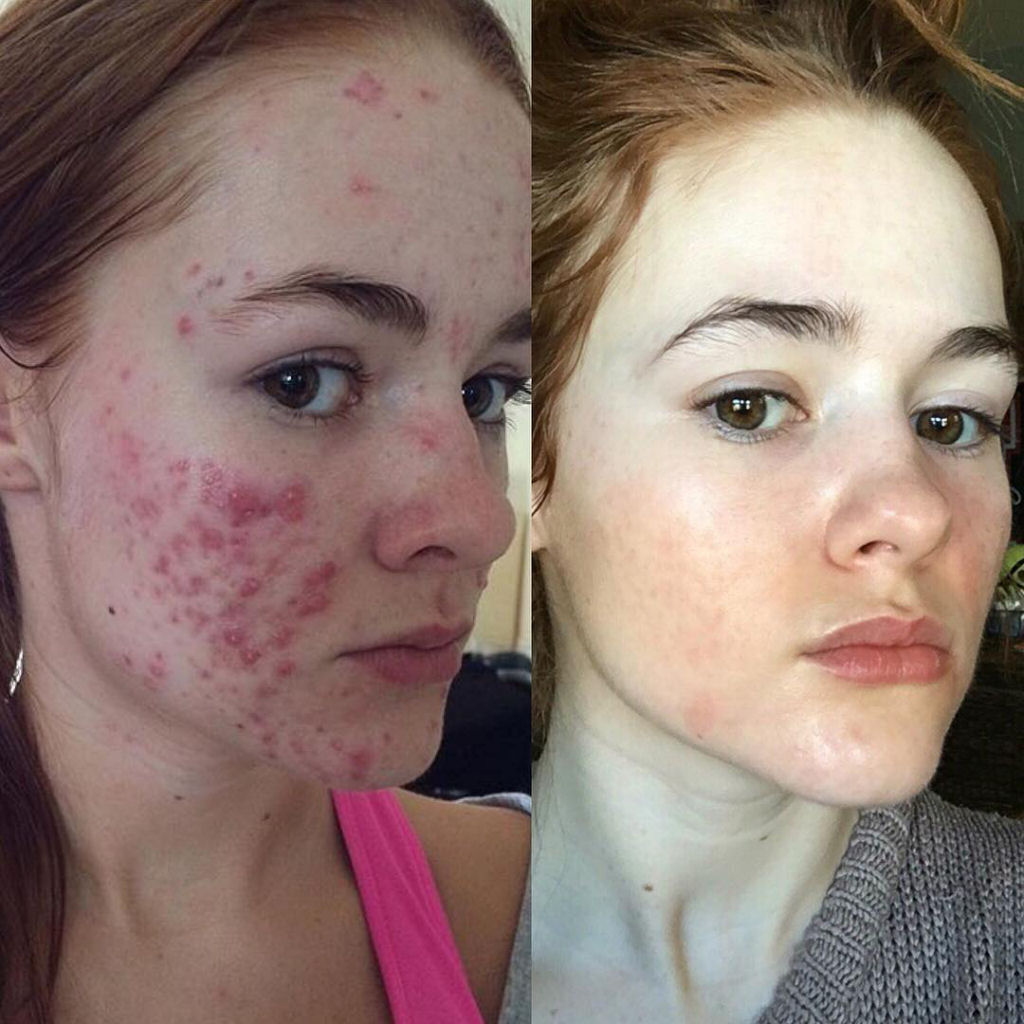O incrível antes e depois desta jovem com acne severa 02