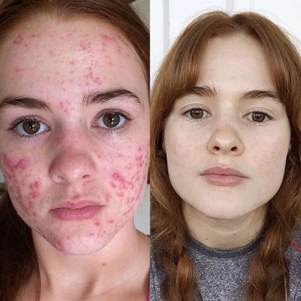 O incrível antes e depois desta jovem com acne severa 03