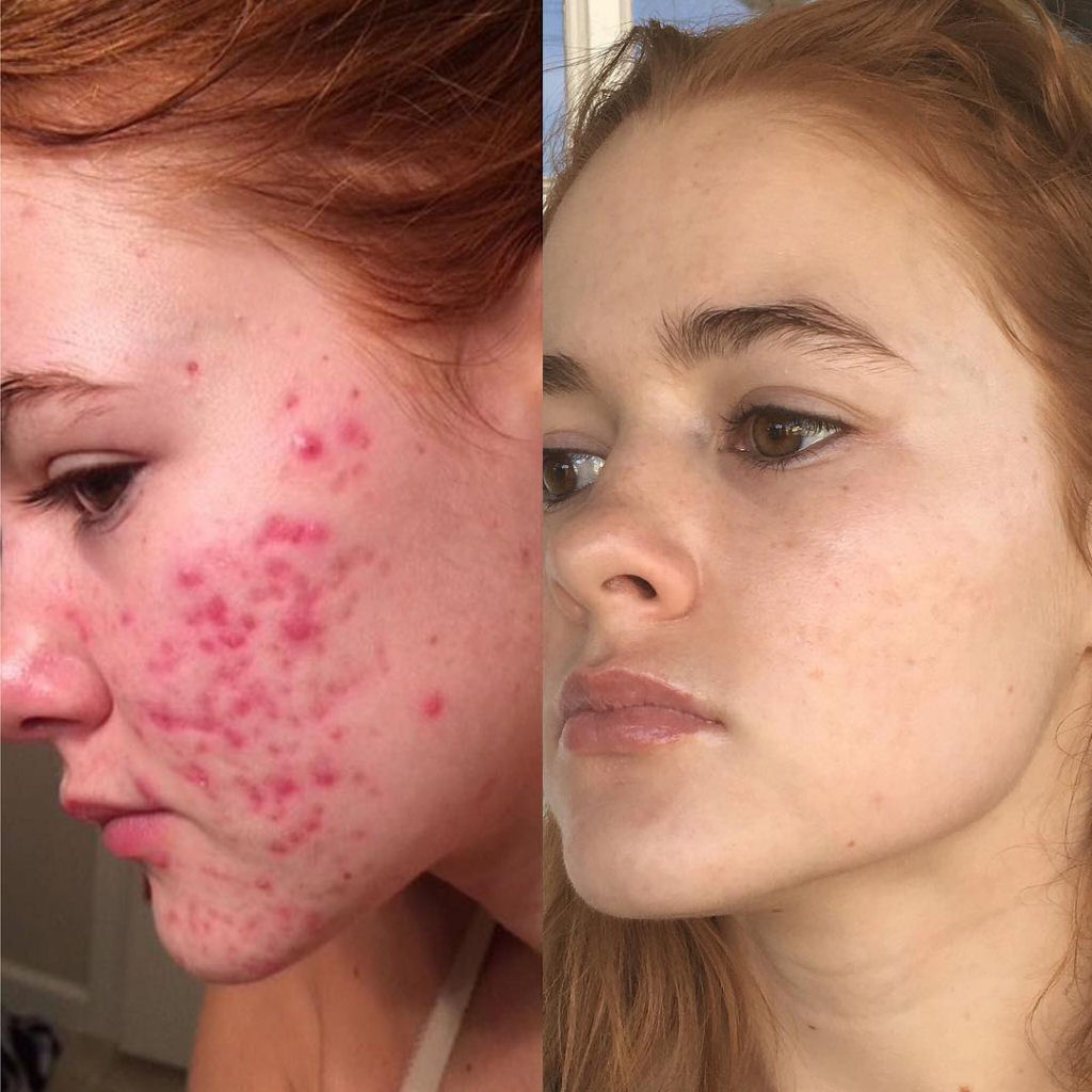 O incrível antes e depois desta jovem com acne severa 04