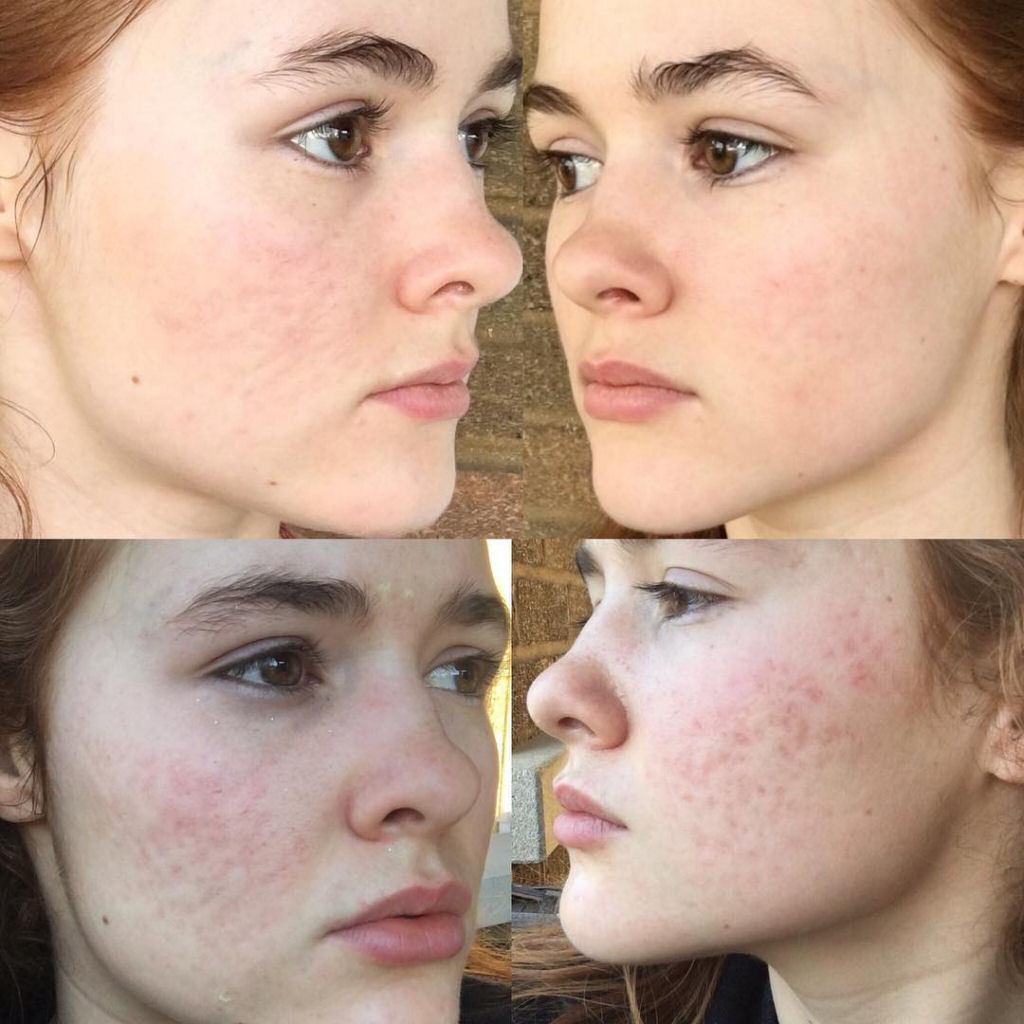 O incrível antes e depois desta jovem com acne severa 05