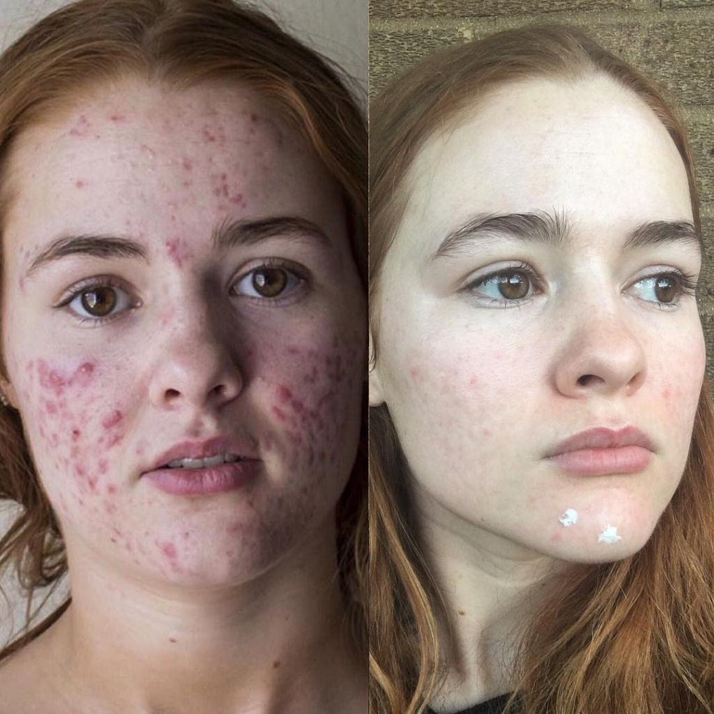O incrível antes e depois desta jovem com acne severa 06