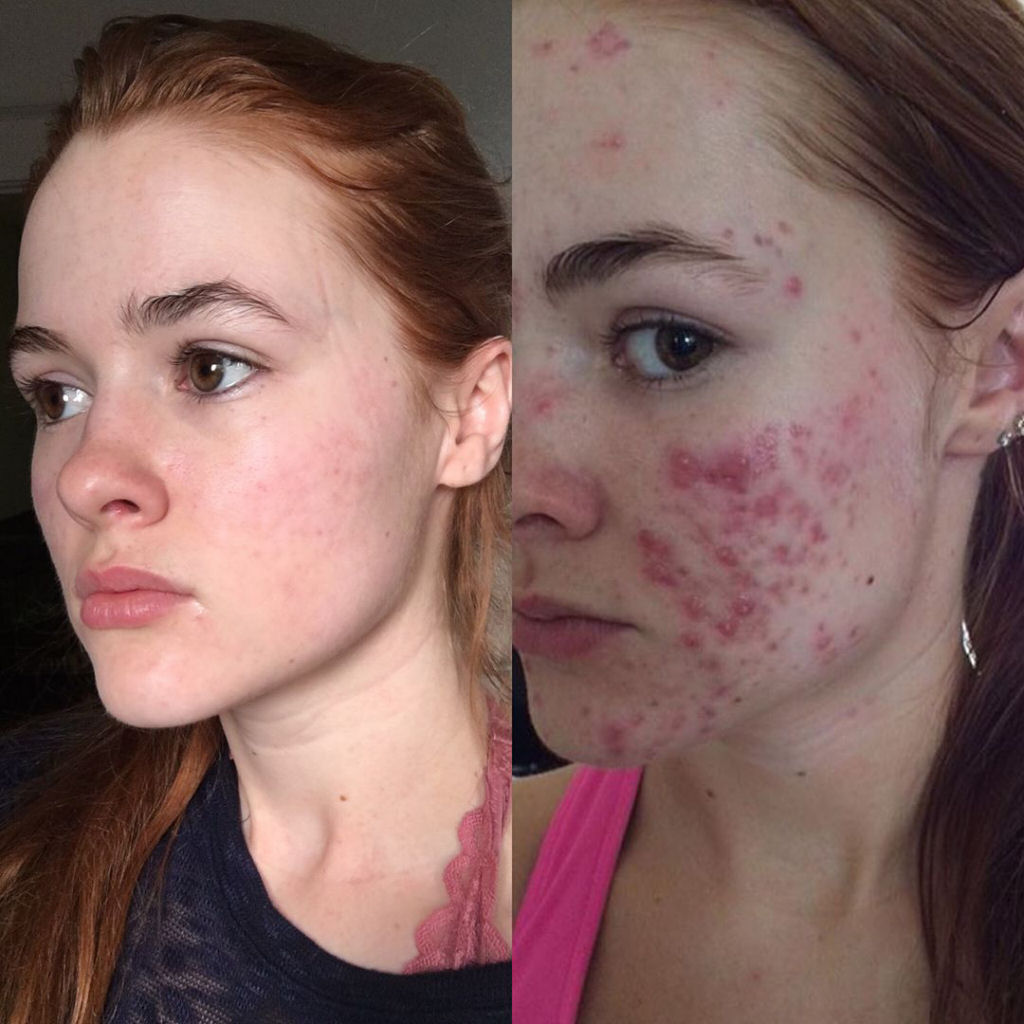 O incrível antes e depois desta jovem com acne severa 07