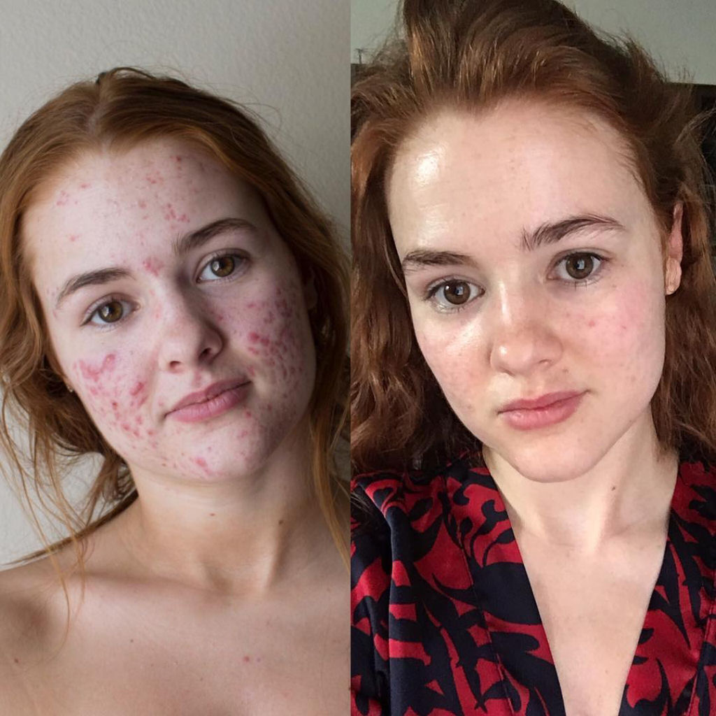 O incrível antes e depois desta jovem com acne severa 08