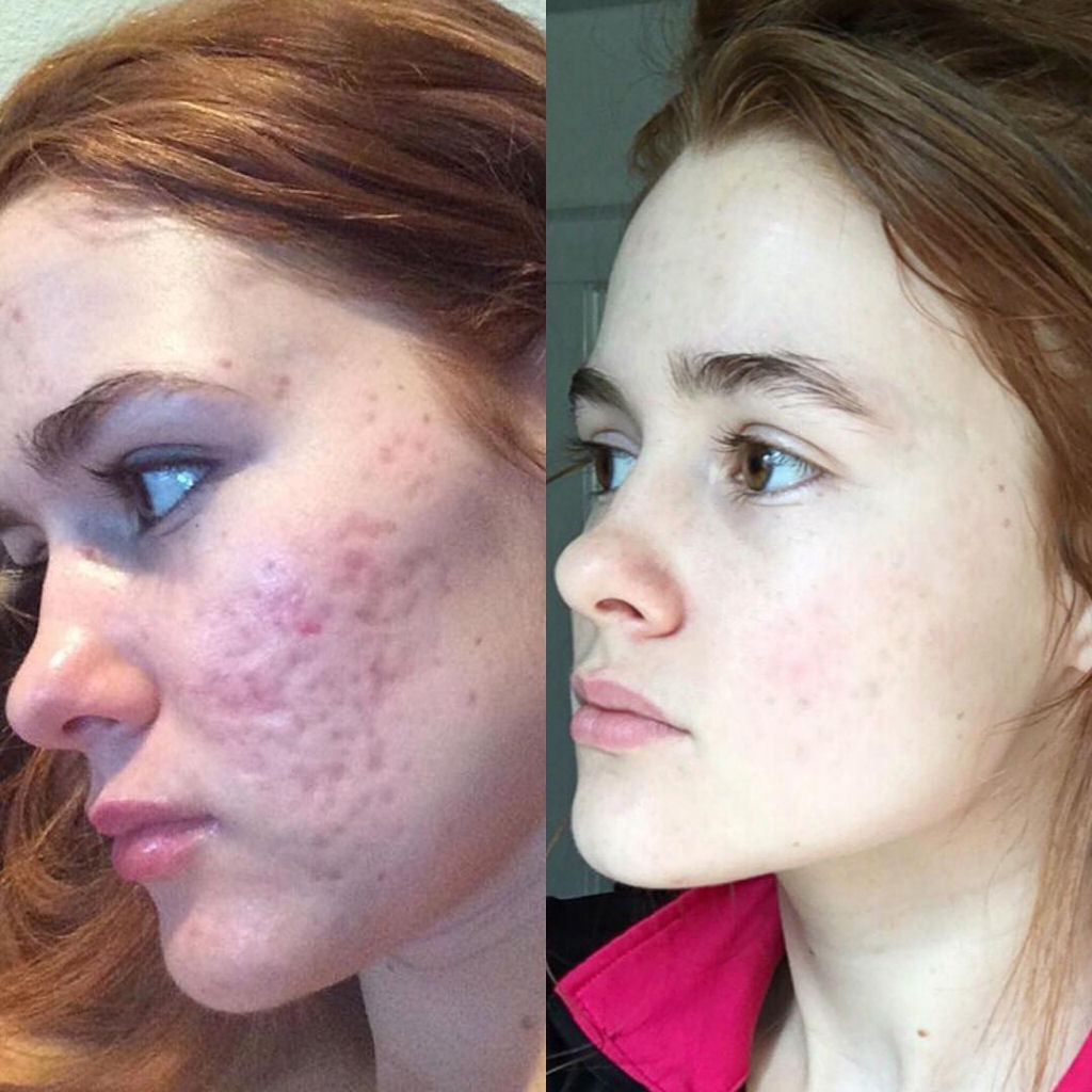 O incrível antes e depois desta jovem com acne severa 09