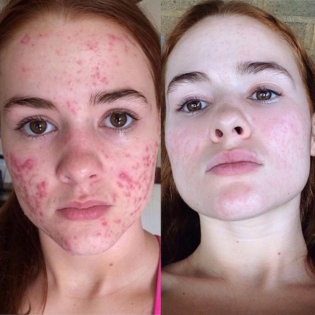 O incrível antes e depois desta jovem com acne severa 11