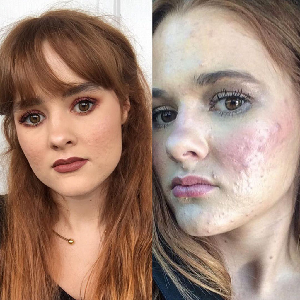 O incrível antes e depois desta jovem com acne severa 12