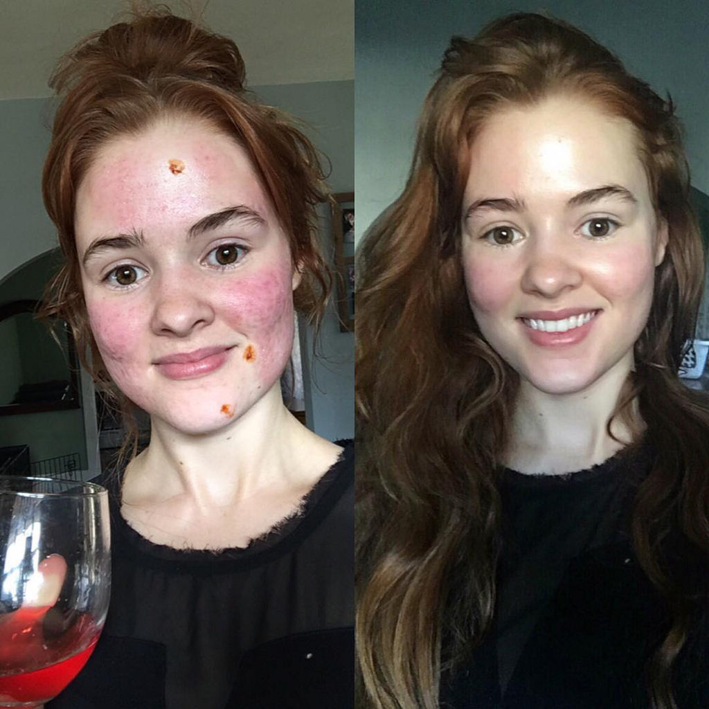 O incrível antes e depois desta jovem com acne severa 13