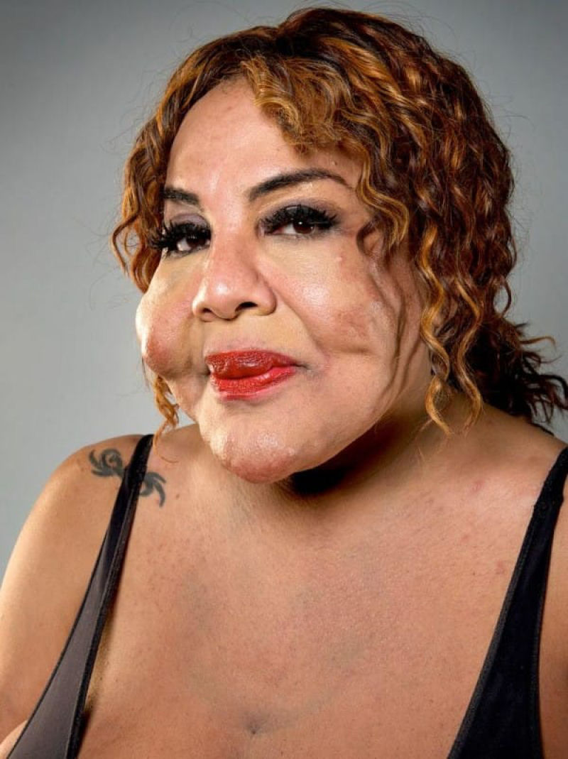 “Médico” injetou cimento em seu rosto, 11 anos depois, ela está completamente transformada 03