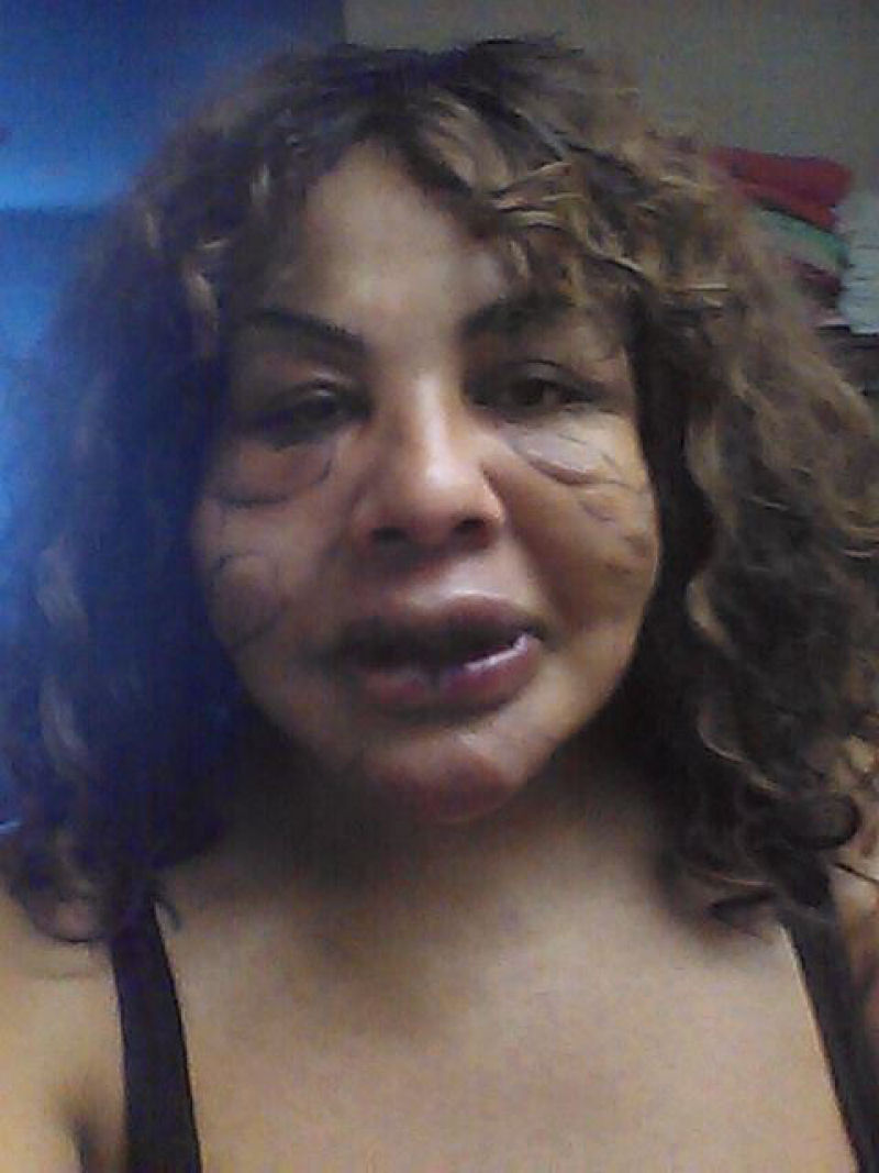 “Médico” injetou cimento em seu rosto, 11 anos depois, ela está completamente transformada 04