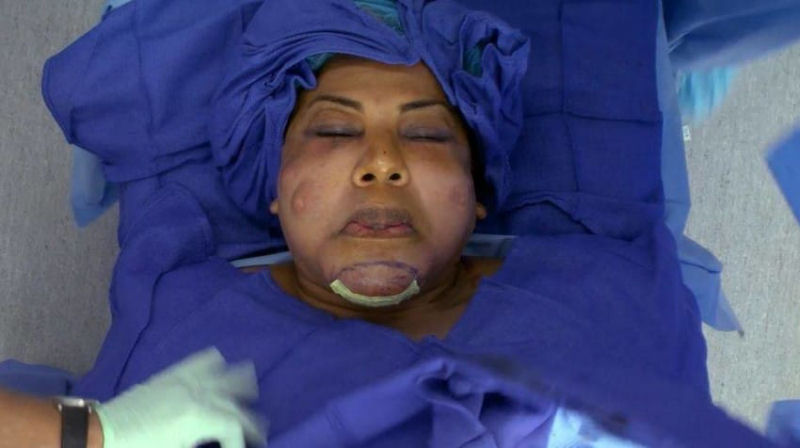 “Médico” injetou cimento em seu rosto, 11 anos depois, ela está completamente transformada 06