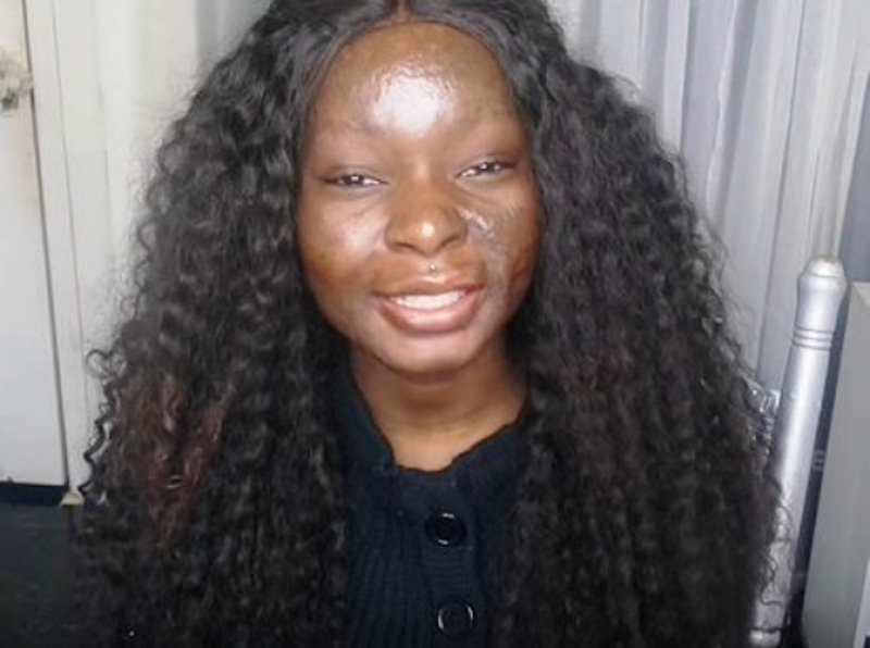 Esta sobrevivente de queimadura mostra o poder da maquiagem como voc nunca viu