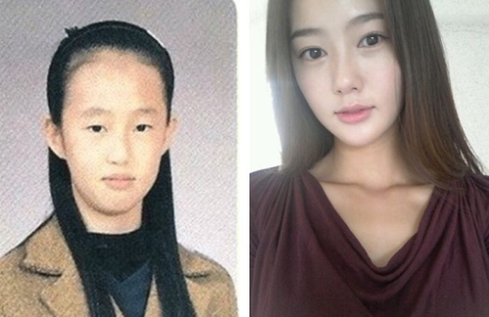 Antes e depois da cirurgia plástica coreana 21