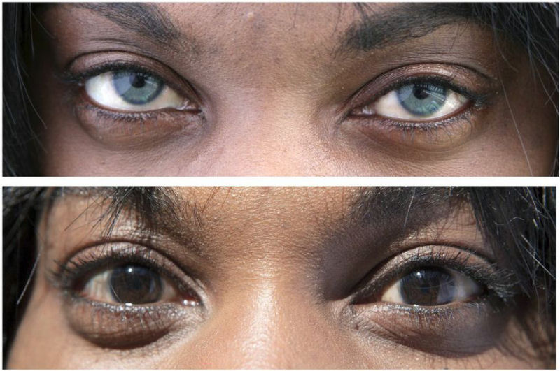 Polmica cirurgia de implante de ris artificial para alterar permanentemente a cor dos olhos
