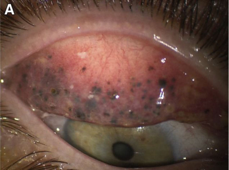 Este foi o horrvel resultado de uma mulher que dormiu mais de 25 anos com maquiagem nos olhos