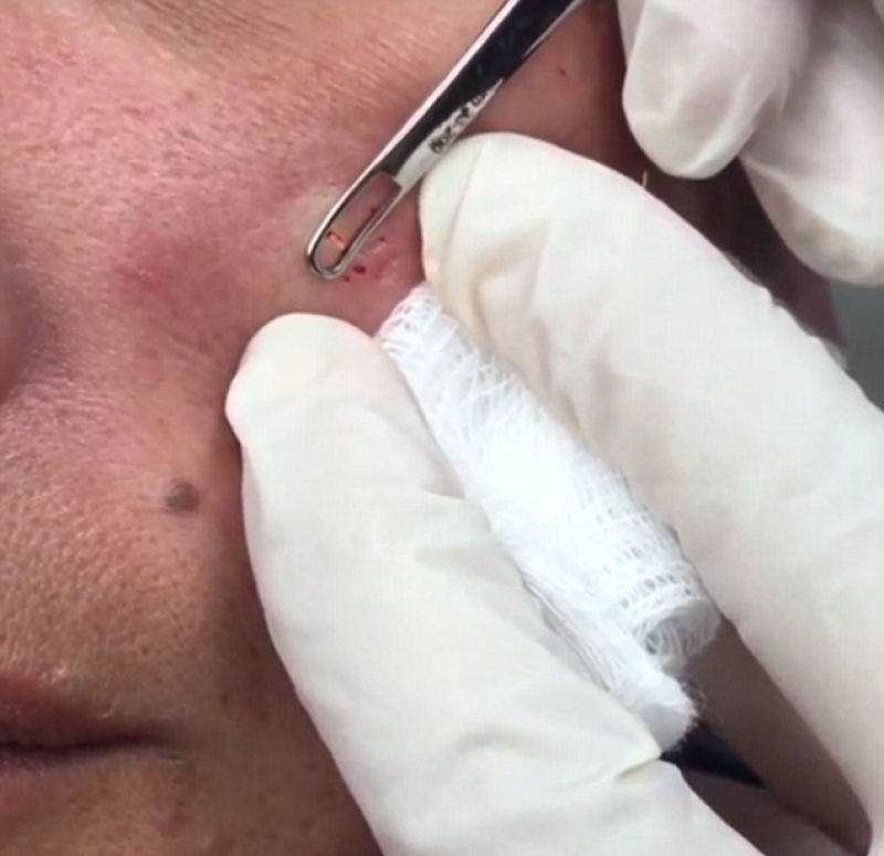 ”Dra. Espremedora de Espinhas” - Dermatologista que filma a si mesma espremendo acne se torna sensação na Internet