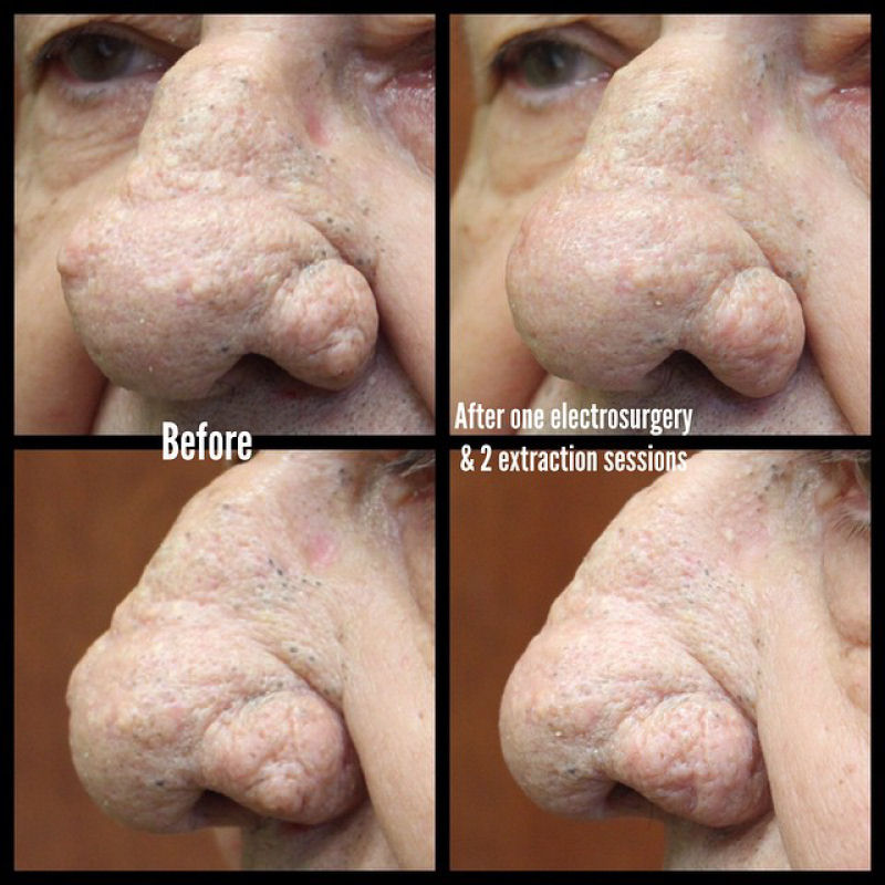 ”Dra. Espremedora de Espinhas” - Dermatologista que filma a si mesma espremendo acne se torna sensação na Internet