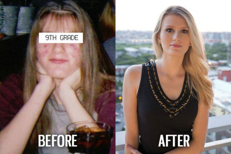 Antes e depois de pessoas com síndrome do patinho feio 04