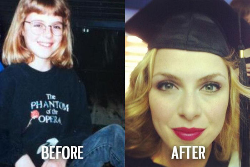 Antes e depois de pessoas com síndrome do patinho feio 06