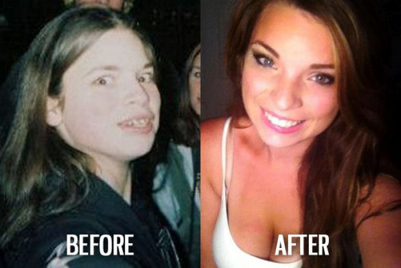 Antes e depois de pessoas com síndrome do patinho feio 08