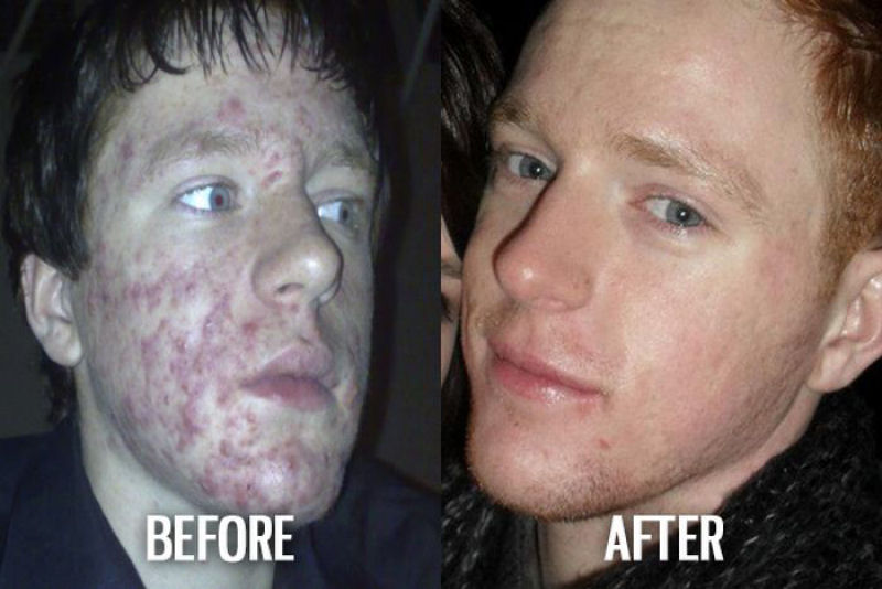 Antes e depois de pessoas com síndrome do patinho feio 10