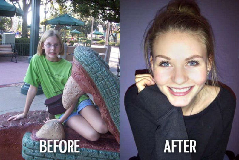 Antes e depois de pessoas com síndrome do patinho feio 11