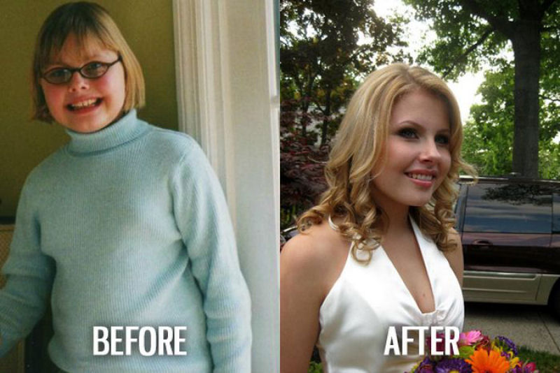 Antes e depois de pessoas com síndrome do patinho feio 14