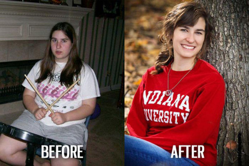 Antes e depois de pessoas com síndrome do patinho feio 15