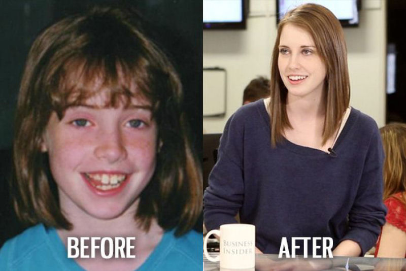 Antes e depois de pessoas com síndrome do patinho feio 16