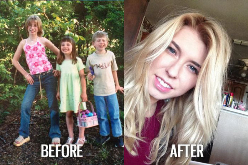 Antes e depois de pessoas com síndrome do patinho feio 18