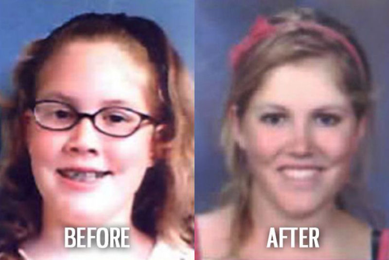 Antes e depois de pessoas com síndrome do patinho feio 22