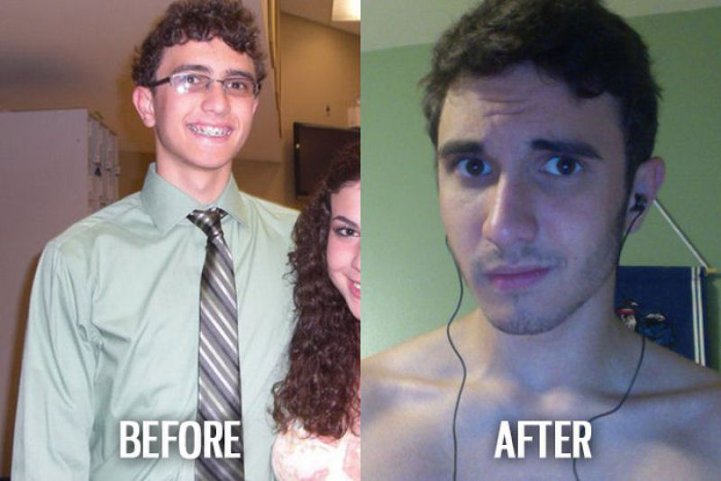 Antes e depois de pessoas com síndrome do patinho feio 26