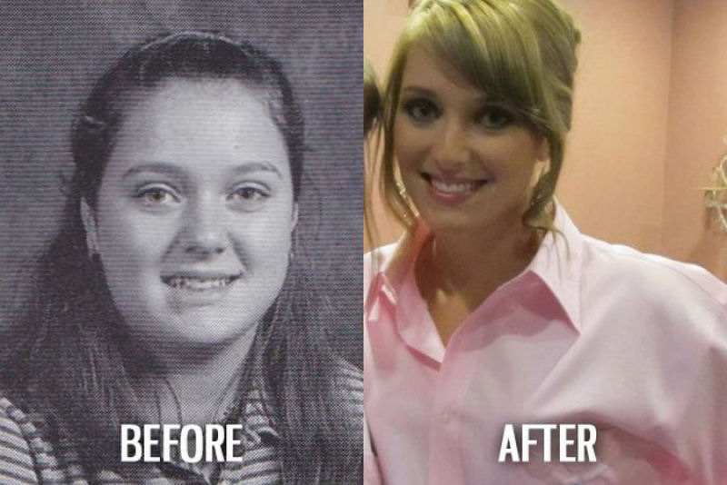 Antes e depois de pessoas com síndrome do patinho feio 27