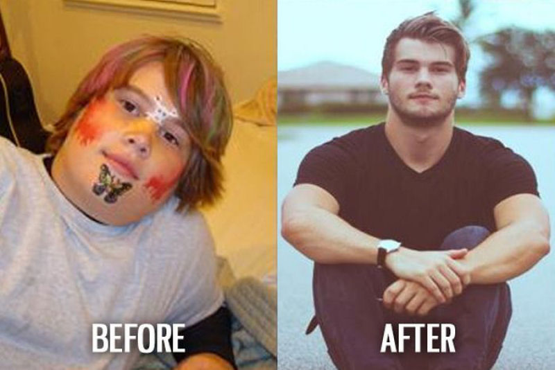 Antes e depois de pessoas com síndrome do patinho feio 28