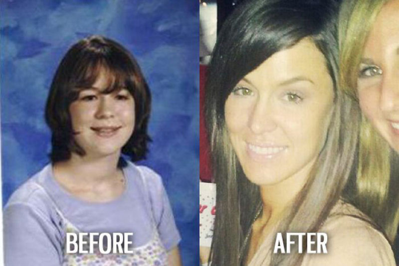 Antes e depois de pessoas com síndrome do patinho feio 31