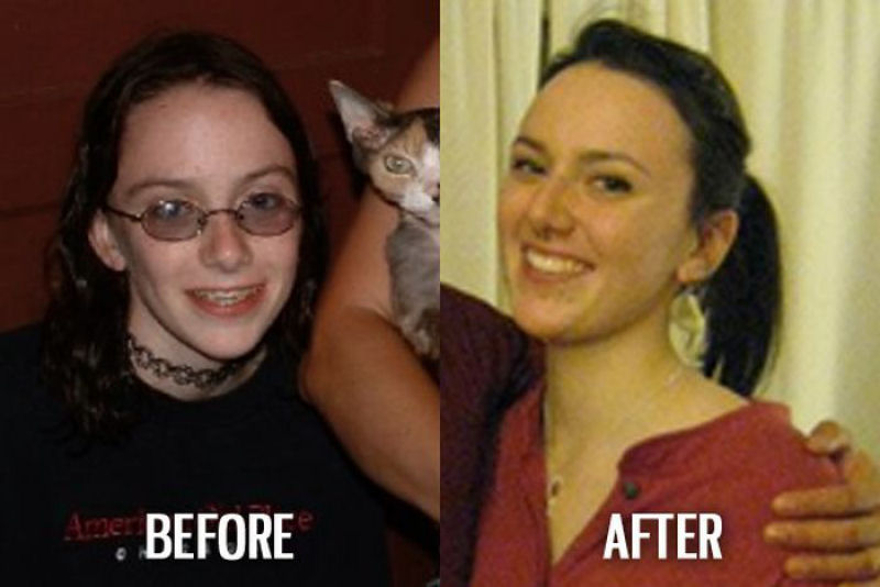 Antes e depois de pessoas com síndrome do patinho feio 35