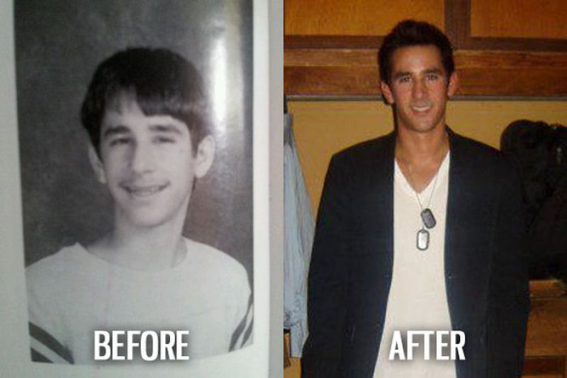 Antes e depois de pessoas com síndrome do patinho feio 39