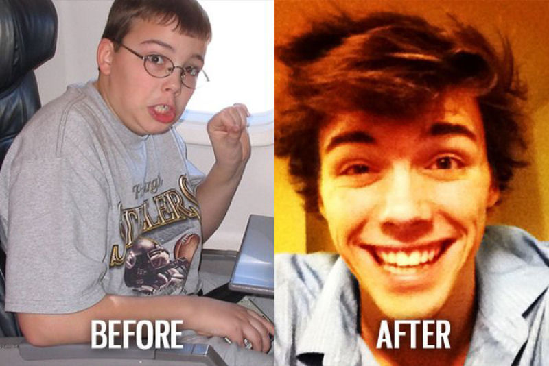 Antes e depois de pessoas com síndrome do patinho feio 43