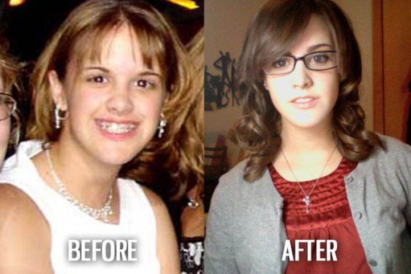 Antes e depois de pessoas com síndrome do patinho feio 45