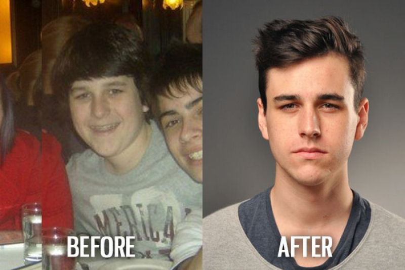 Antes e depois de pessoas com síndrome do patinho feio 48