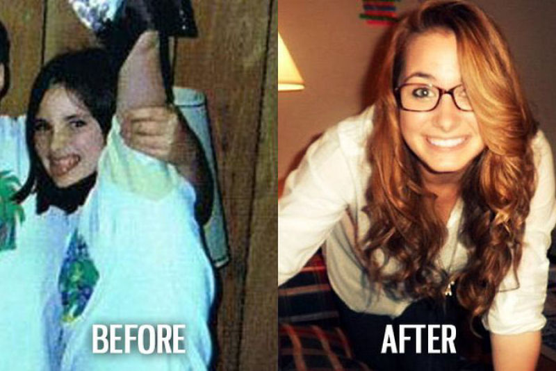 Antes e depois de pessoas com síndrome do patinho feio 51