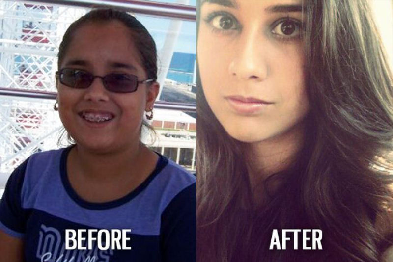 Antes e depois de pessoas com síndrome do patinho feio 52